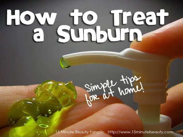 How to treat a sunburn