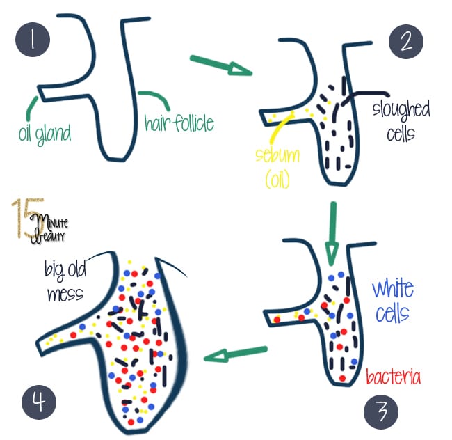 Acne Pathophysiology