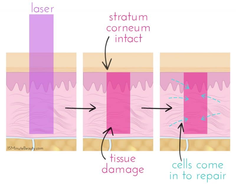 how does nonablative laser resurfacing work?