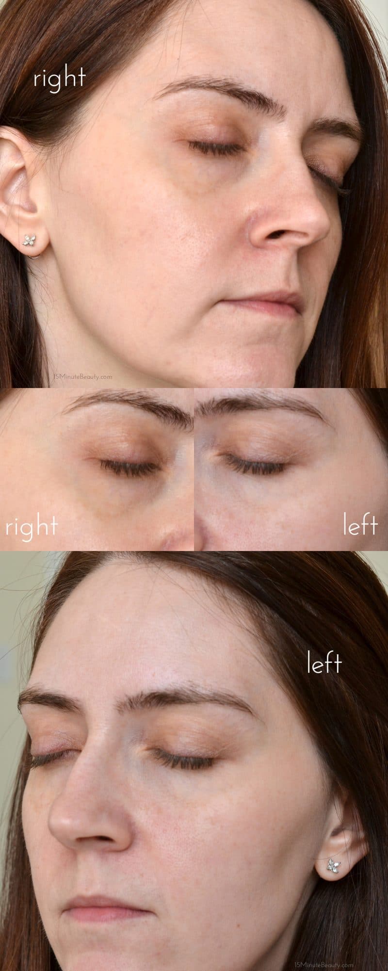 Tria Age Defying Laser 3 weeks of use