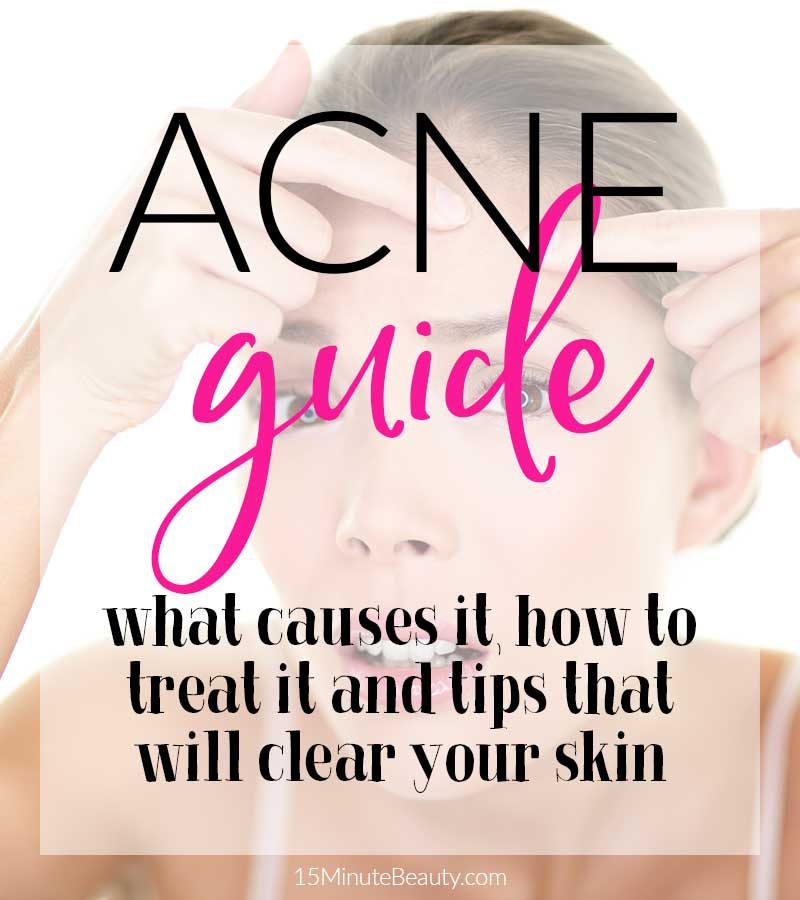 Acne Basics Guide