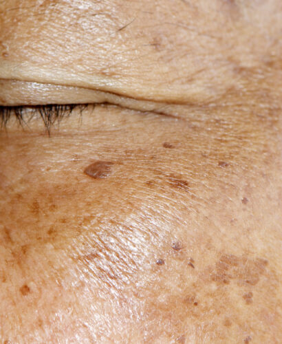 Postpartum Melasma