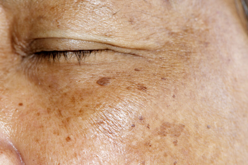 Postpartum Melasma