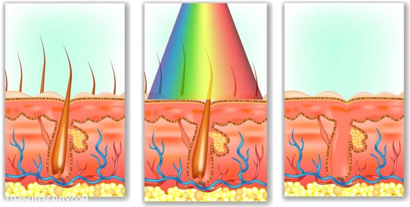 how ipl hair removal works- graphic illustration