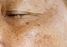 Postpartum Melasma